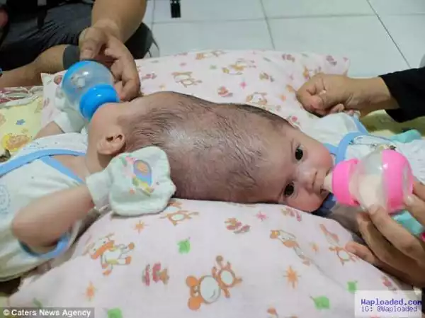 Woman delivers twin baby girls who share a skull (photos)